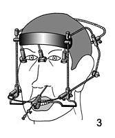 Устройство для прицельных манипуляций на голове